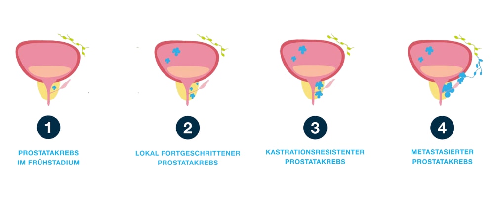 4 Grafiken zu den Stadien bei Prostatakrebs